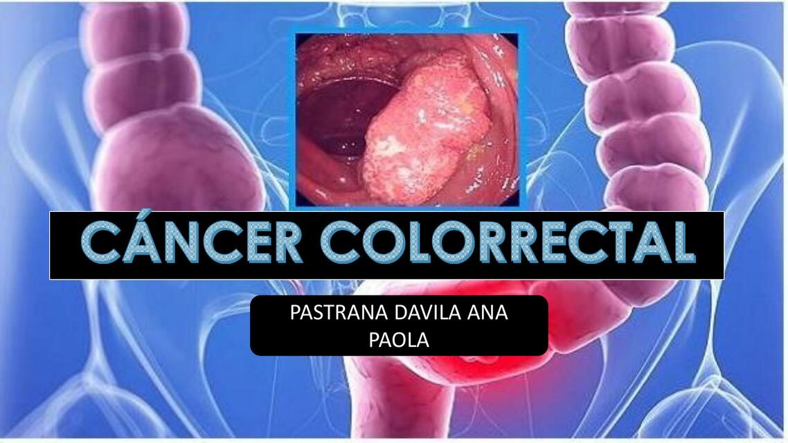 Cáncer Colorrectal 