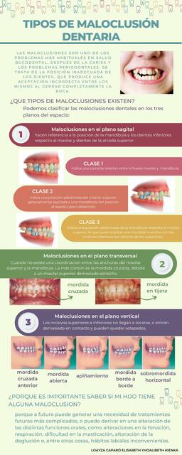 Tipos de Maloclusiones Dentarias