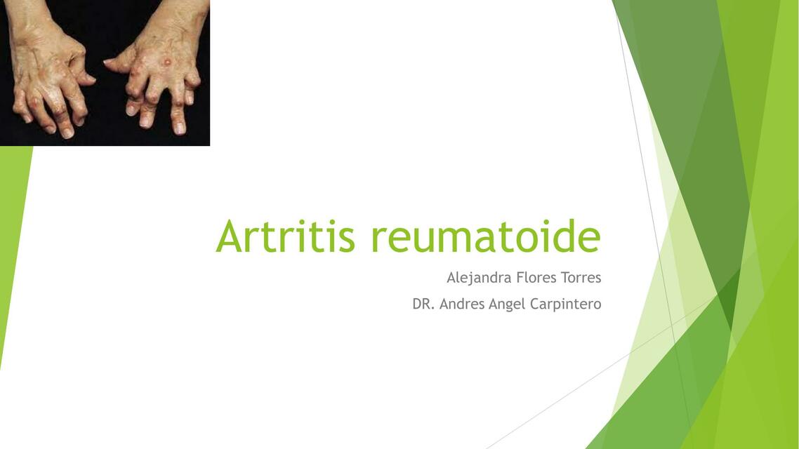 Artritis reumatoide 