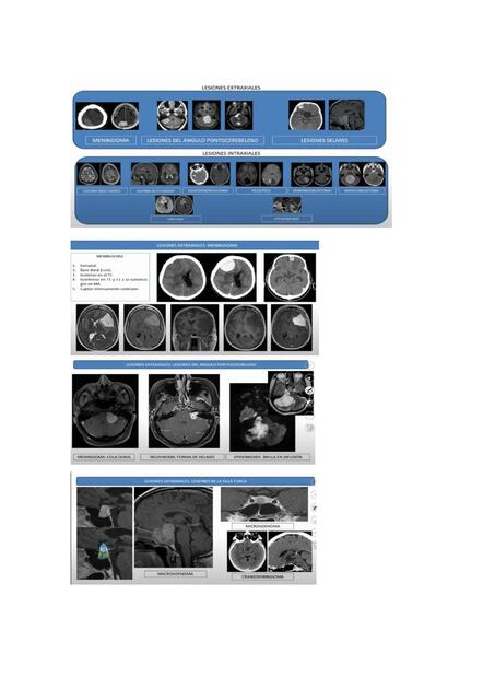 Tumores Intracraneales