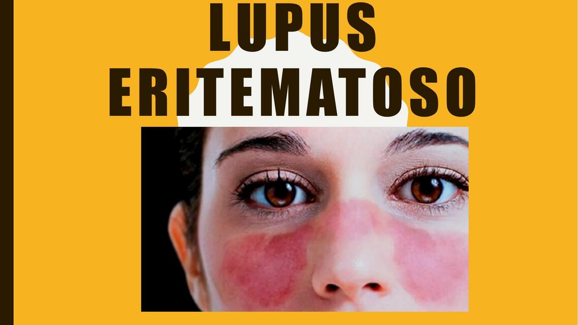 Lupus Eritematoso 