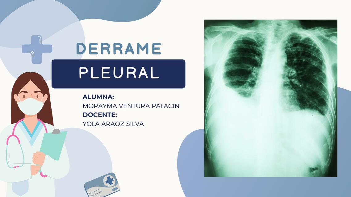 Derrame pleural