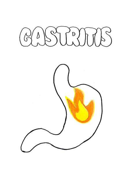 Gastritis Jpaul Hasto Udocz