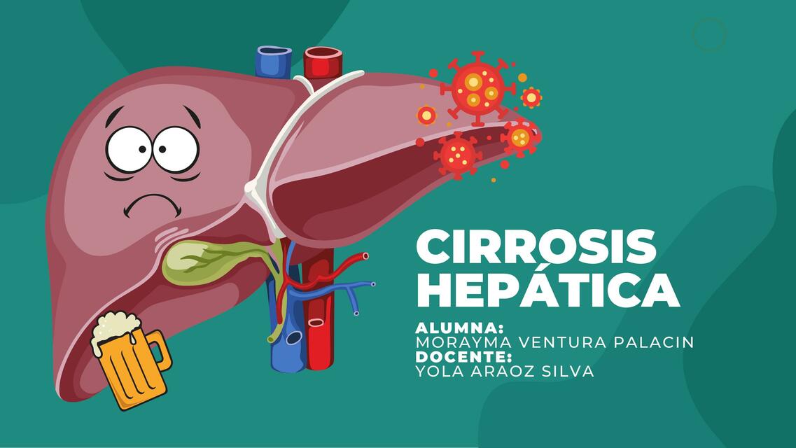 Cirrosis Hepática 