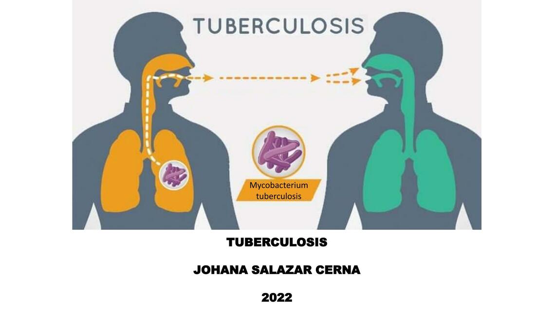 Tuberculosis