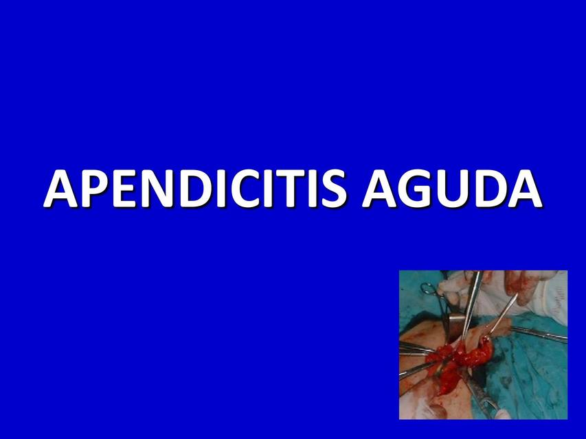Apendicitis aguda | uDocz