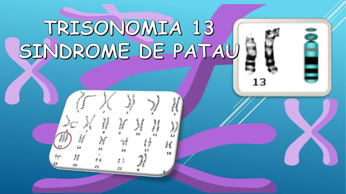 Trisomía 13- Síndrome de Patau 