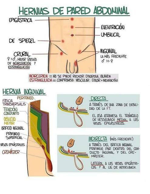 Hernias De Pared Abdominal Fraii Udocz