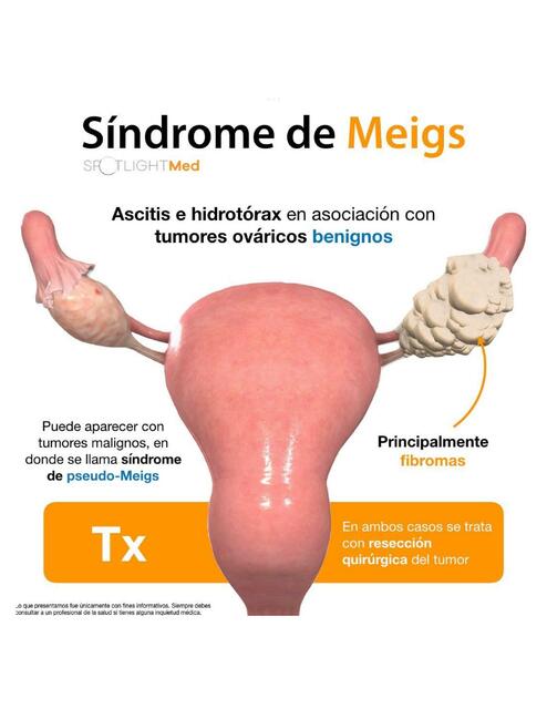 Síndrome de Meigs uDocz Síndrome de Meigs uDocz