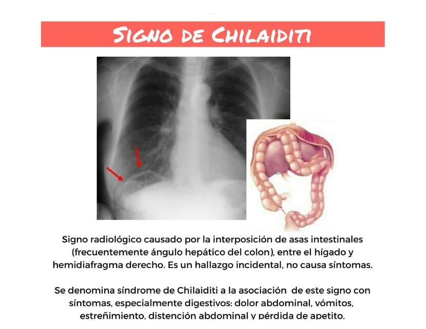 Signo de Chilaiditi | uDocz