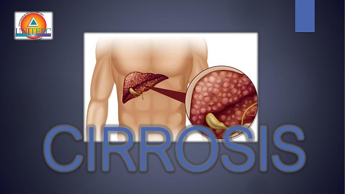 CIRROSIS HEPATICA -peritoneo-ascitis SEMIOLOGIA