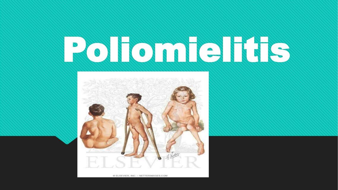 Poliomielitis