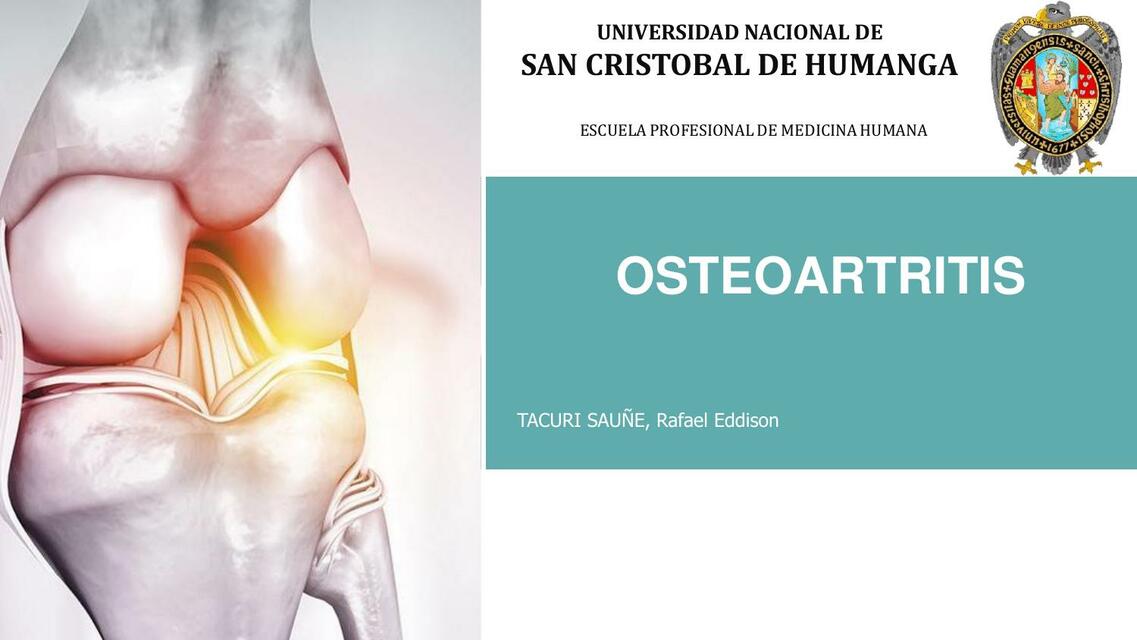 Osteoartritis 