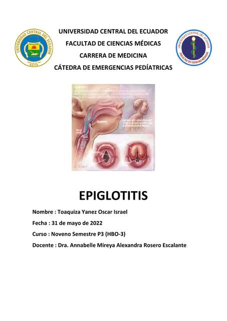 Epiglotitis 