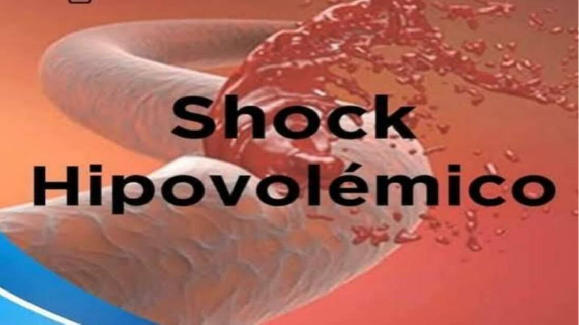 Shock Hipovolémico