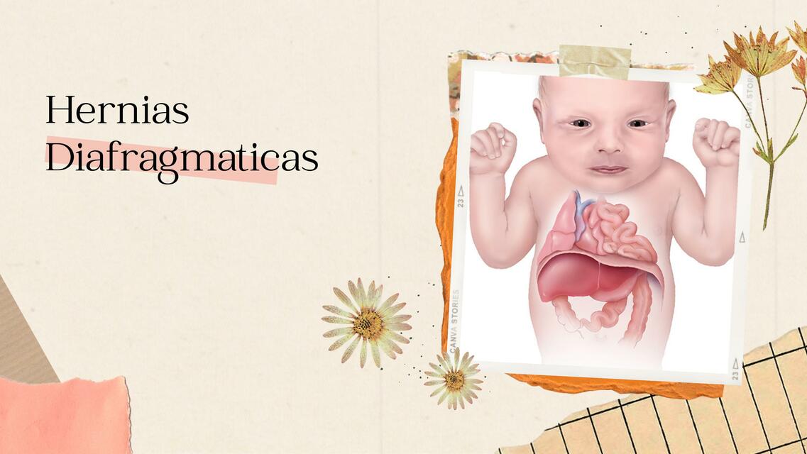 Hernias Diafragmáticas