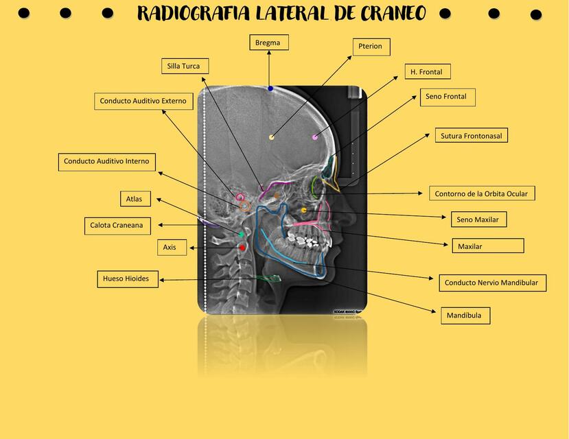 Radiografía Lateral de Cráneo 