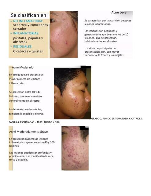 Dermatología - Acné