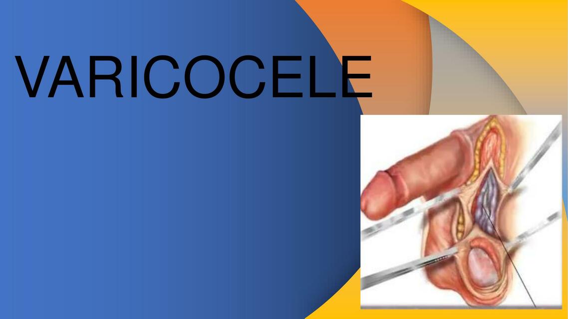 Varicocele