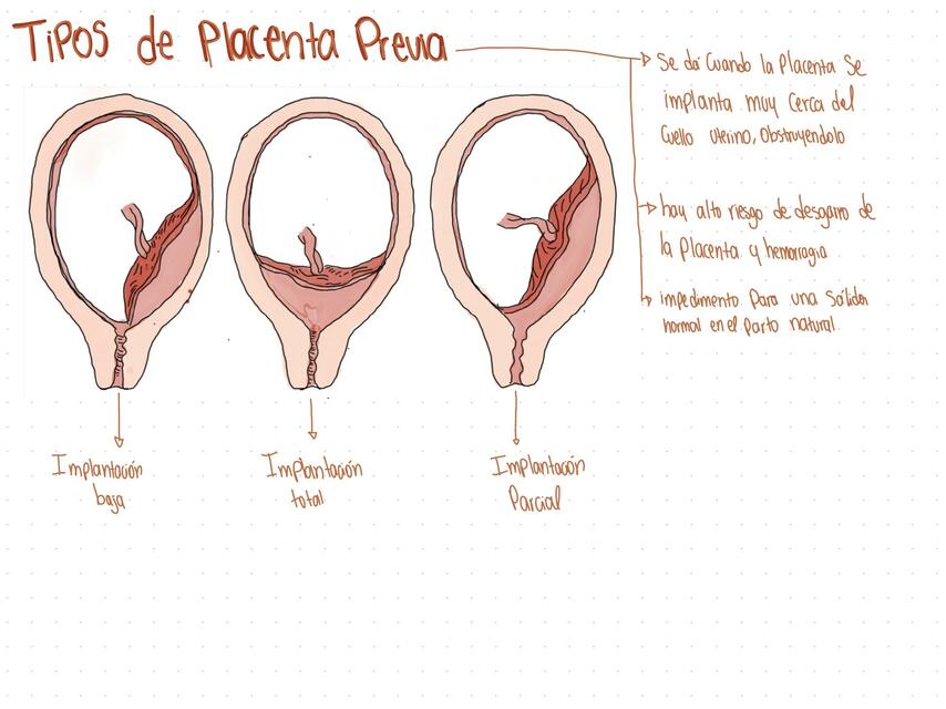 Tipos de Placenta | Chiqui Rojita | uDocz