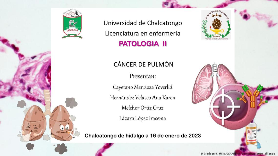 Cáncer de pulmón 