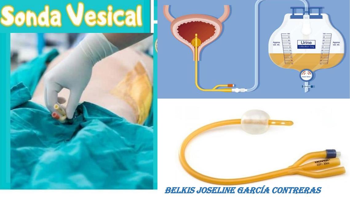 Sonda vesical 