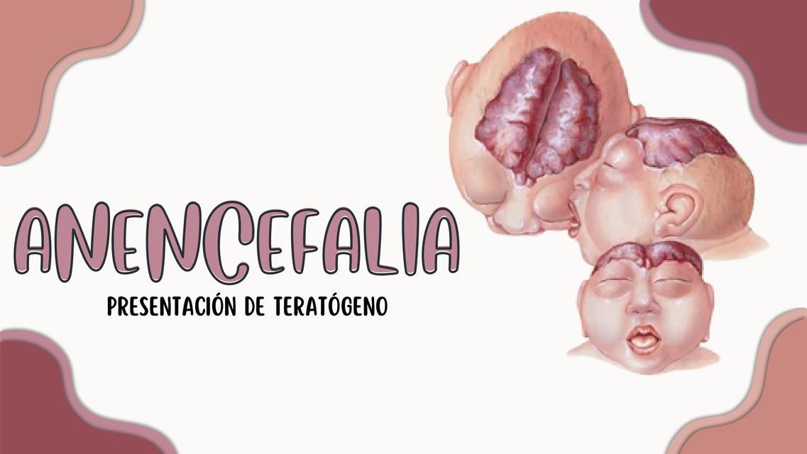 Anencefalia  