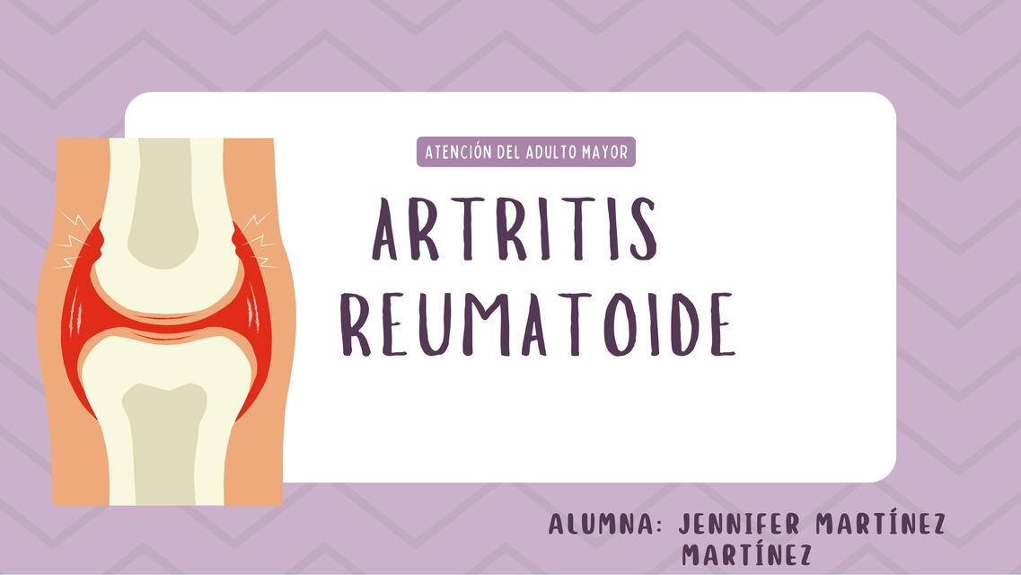 Artritis reumatoide