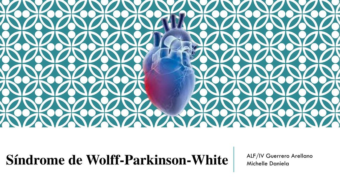 Síndrome de Wolff Parkinson- White