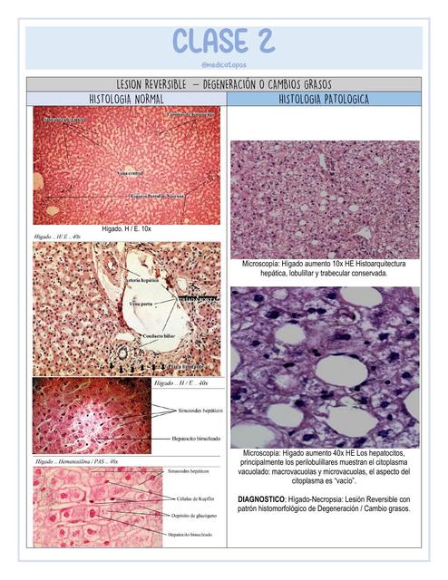 Lesion reversible - Degeneración o cambios grasos