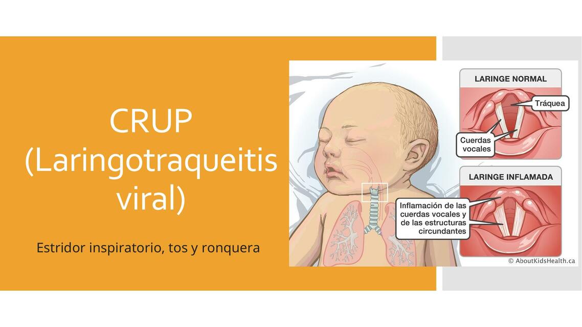 CRUP (Laringotraqueitis)