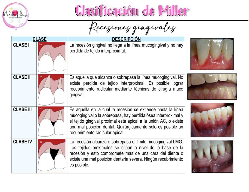 Clasificación de Miller