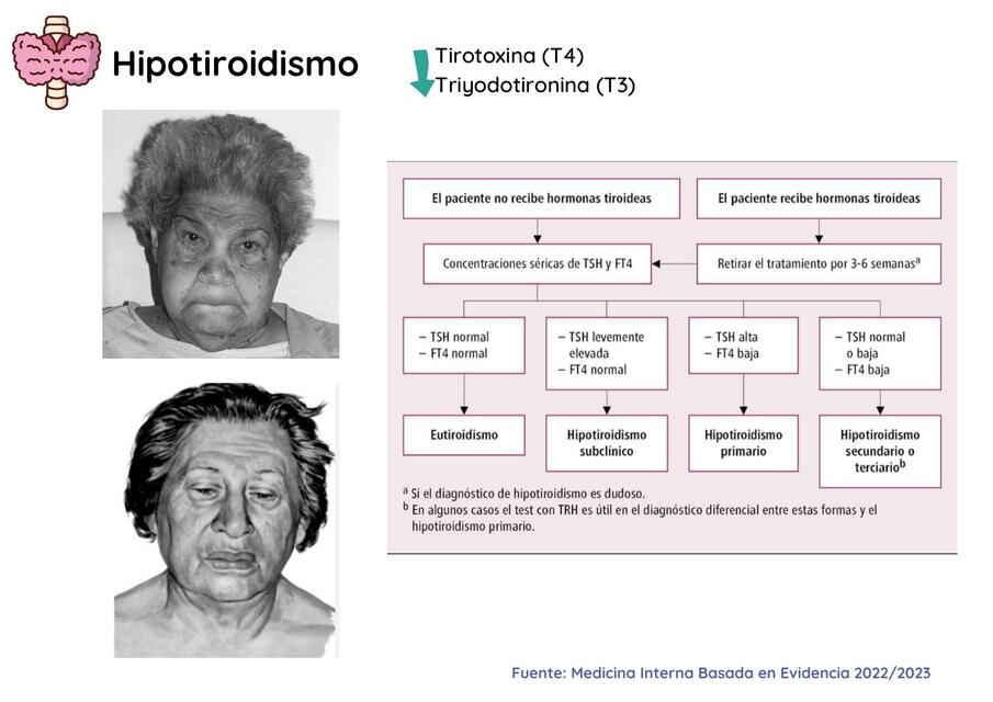 Hipotiroidismo