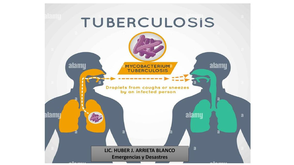 Tuberculosis