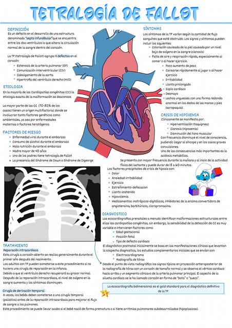 Tetralogía de Fallot 