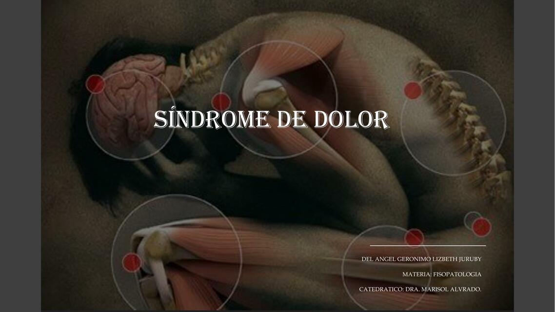 Síndrome de Dolor