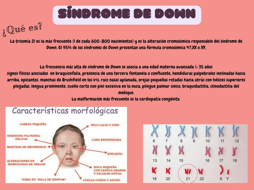 Síndrome de Down