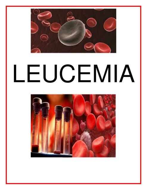 Leucemia 