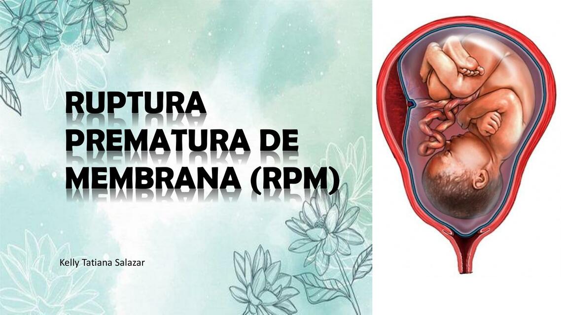 Ruptura prematura de membrana (RPM)