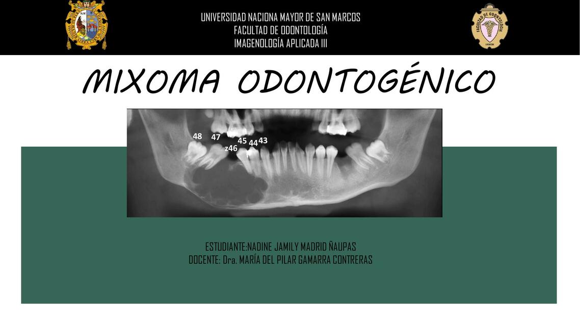 Mixoma Odontogénico 