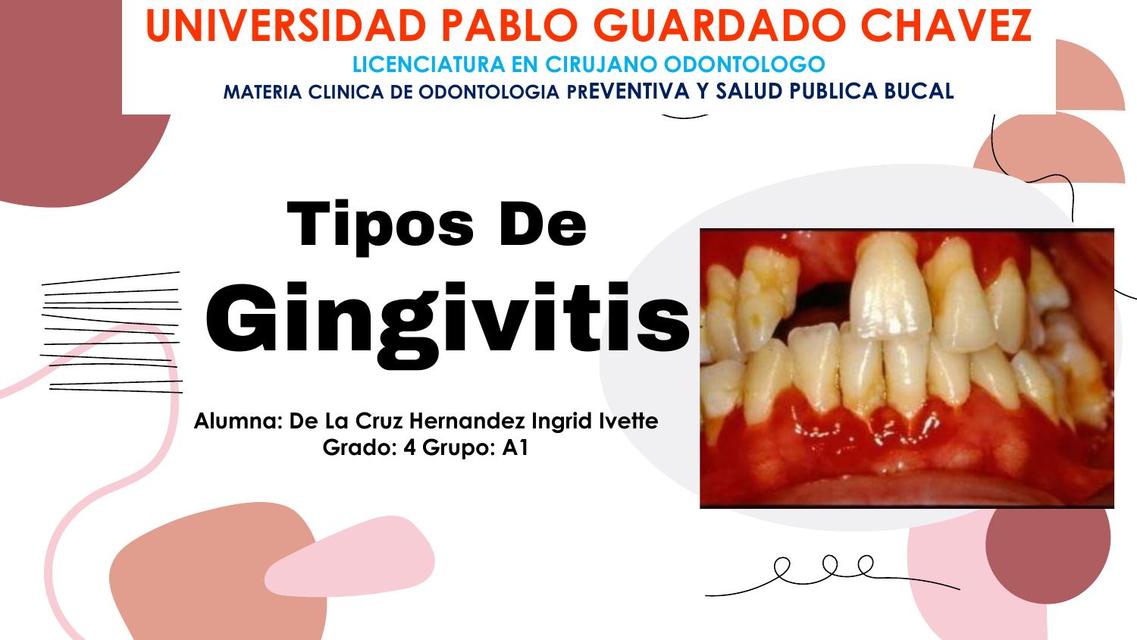 Tipos de Gingivitis 