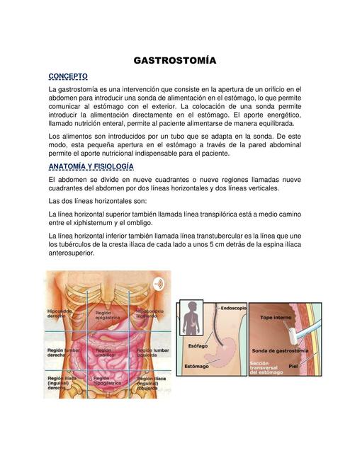 Gastrostomía 