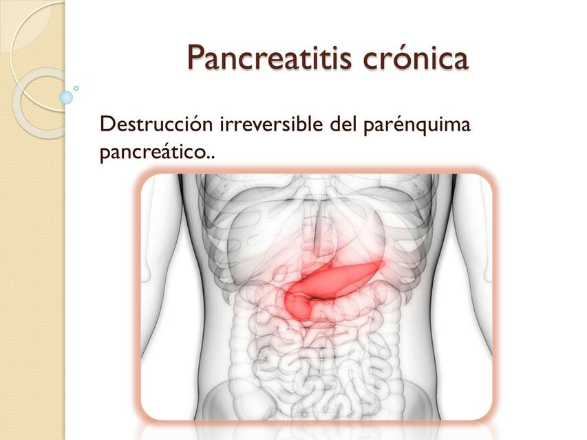 Pancreatitis Crónica 