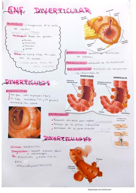 Enfermedad Diverticular 