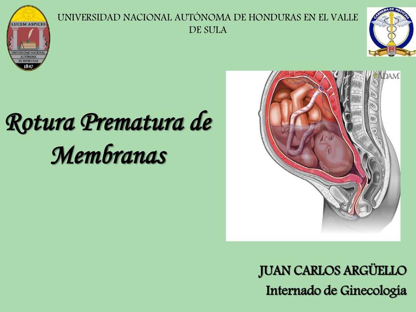 Rotura Prematura de Membranas 