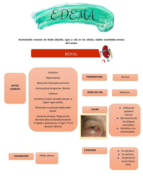 Edema 