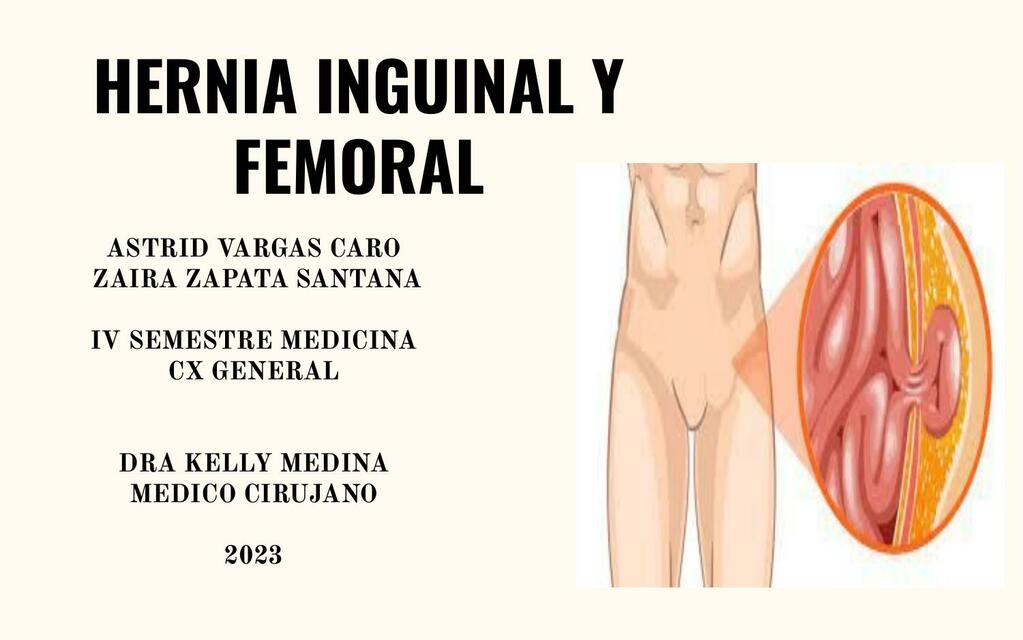 Hernia inguinal y femoral