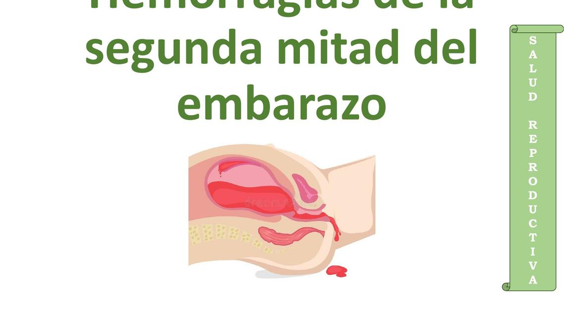 Hemorragias de la segunda mitad del embarazo