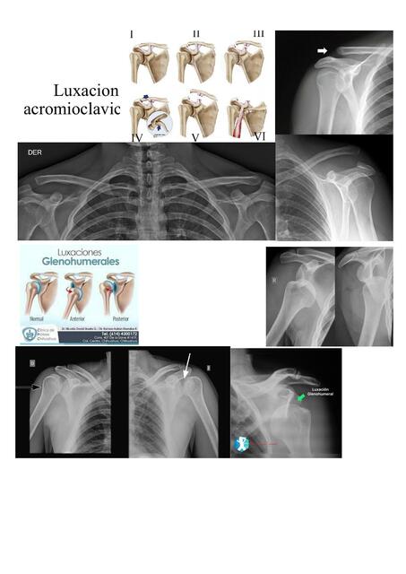 Luxación acromioclavicula