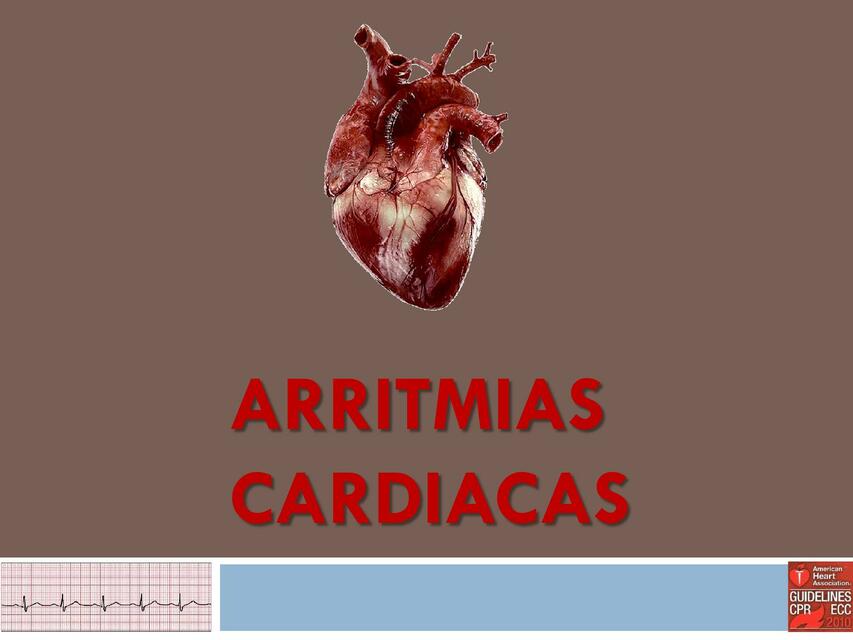 Arritmias Cardiacas  